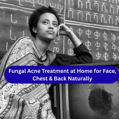 Fungal Acne Treatment at Home for Face, Chest & Back Naturally