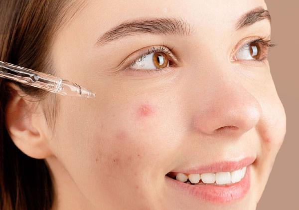 Best Skincare Products for Acne-Prone Skin in the USA (2026)